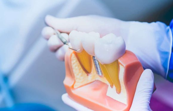 Rehabilitación Completa de la Boca con Implantes Dentales: Una Guía Integral
