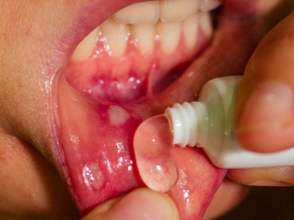 Benign Tumors of the Oral Cavity