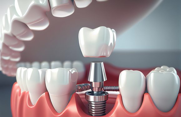 Bursting Common Misconceptions About Dental Implants