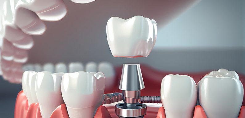 Bursting Common Misconceptions About Dental Implants